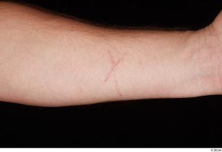 Louis forearm nude scar 0001.jpg